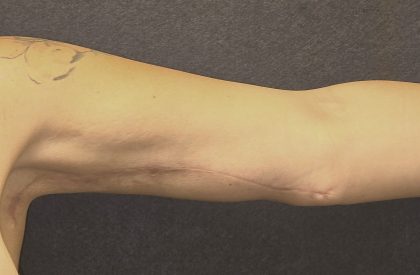 Arm Reduction Before & After Patient #3579