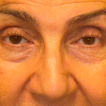 Blepharoplasty Before & After Patient #3669