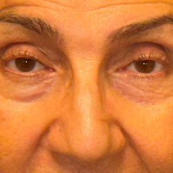 Blepharoplasty Before & After Patient #3669