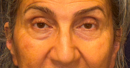 Blepharoplasty Before & After Patient #3669