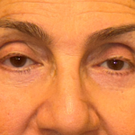 Blepharoplasty Before & After Patient #3669