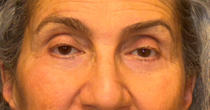 Blepharoplasty Before & After Patient #3669