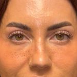 Blepharoplasty Before & After Patient #3724