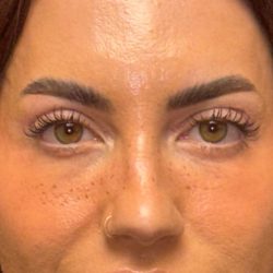 Blepharoplasty Before & After Patient #3724