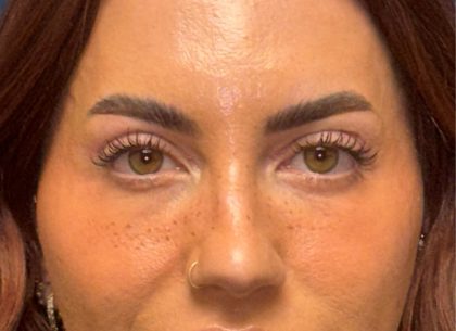 Blepharoplasty Before & After Patient #3724