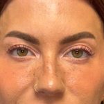 Blepharoplasty Before & After Patient #3724