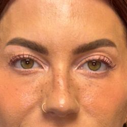 Blepharoplasty Before & After Patient #3724