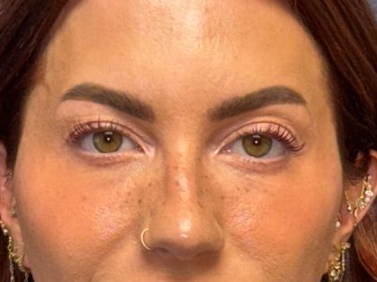 Blepharoplasty Before & After Patient #3724