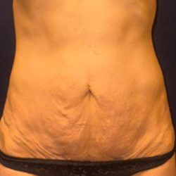 Abdominoplasty Before & After Patient #3761
