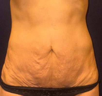 Abdominoplasty Before & After Patient #3761