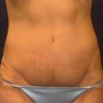 Abdominoplasty Before & After Patient #3761