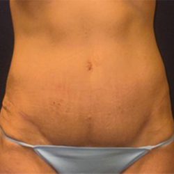 Abdominoplasty Before & After Patient #3761