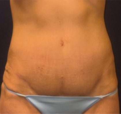 Abdominoplasty Before & After Patient #3761