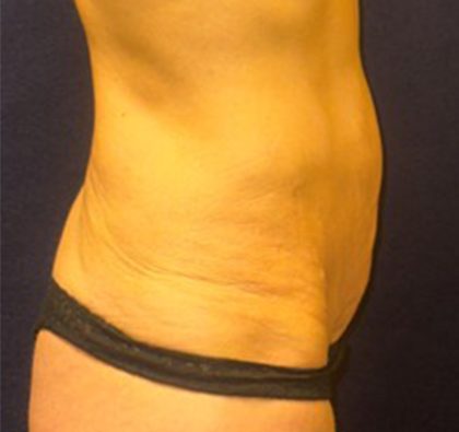 Abdominoplasty Before & After Patient #3761