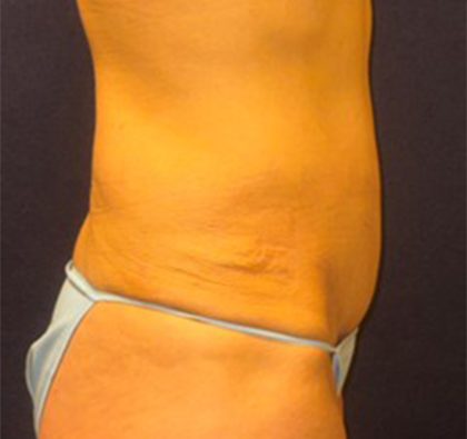 Abdominoplasty Before & After Patient #3761