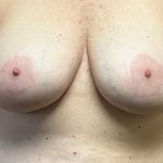 Breast Implant Removal Before & After Patient #3782