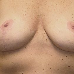 Breast Implant Removal Before & After Patient #3782