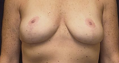 Breast Implant Removal Before & After Patient #3782