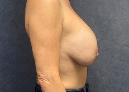 Breast Reagumentation Before & After Patient #3777