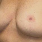 Breast Implant Removal Before & After Patient #3782