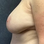 Breast Implant Removal Before & After Patient #3782