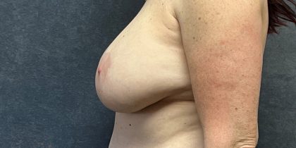 Breast Implant Removal Before & After Patient #3782