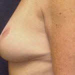 Breast Implant Removal Before & After Patient #3782
