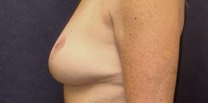 Breast Implant Removal Before & After Patient #3782