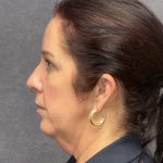 Facelift Before & After Patient #3789