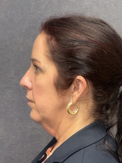 Facelift Before & After Patient #3789