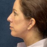 Facelift Before & After Patient #3789