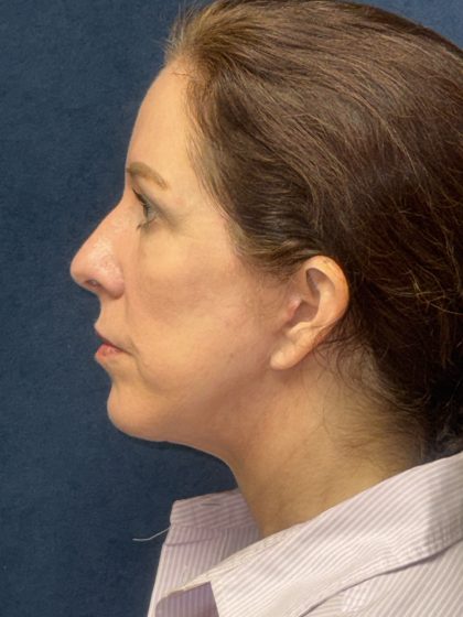 Facelift Before & After Patient #3789