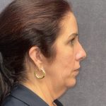 Facelift Before & After Patient #3789