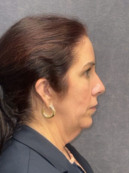 Facelift Before & After Patient #3789