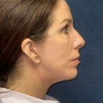 Facelift Before & After Patient #3789