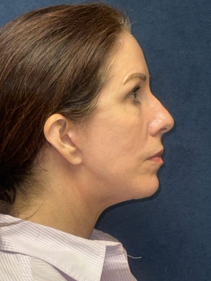 Facelift Before & After Patient #3789