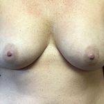 Breast Augmentation Before & After Patient #3798