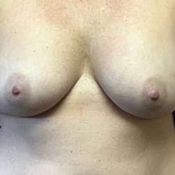 Breast Augmentation Before & After Patient #3798