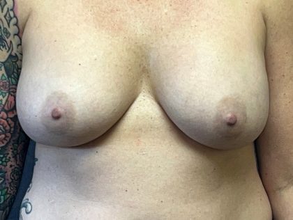 Breast Augmentation Before & After Patient #3798