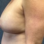 Breast Augmentation Before & After Patient #3798