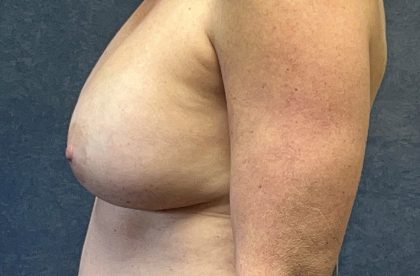 Breast Augmentation Before & After Patient #3798