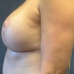 Breast Augmentation Before & After Patient #3798