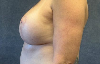 Breast Augmentation Before & After Patient #3798